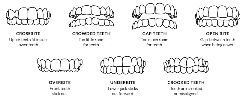 Invisalign Smile Assessment | North York Dentist | York Lanes Dental Centre